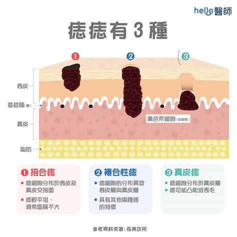 身體長誌|痣形成的原因？痣長毛、痣變多變大是痣病變？5招判。